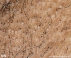 fox-fordyce disease