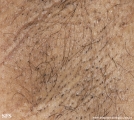 fox-fordyce disease