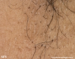 fox-fordyce disease