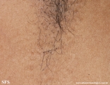 fox-fordyce disease