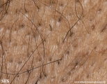 fox-fordyce disease