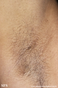 fox-fordyce disease