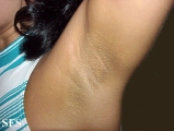 fox-fordyce disease