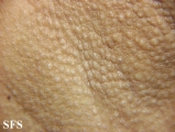 fox-fordyce disease