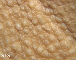 fox-fordyce disease