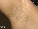 fox-fordyce disease