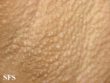 fox-fordyce disease