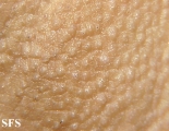 fox-fordyce disease
