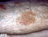 majocchi's disease