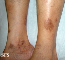 majocchi's disease