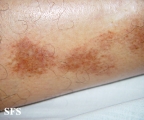 majocchi's disease