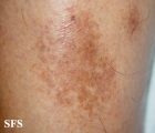 majocchi's disease