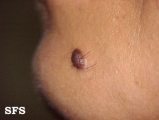epidermal naevi