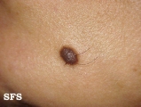 epidermal naevi