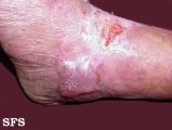 epidermolysis bullosa dystrofic dominant