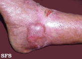 epidermolysis bullosa dystrofic dominant