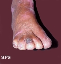 epidermolysis bullosa dystrofic dominant