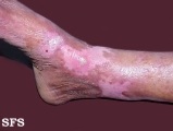 epidermolysis bullosa dystrofic dominant
