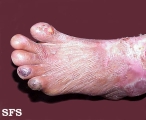 epidermolysis bullosa dystrofic dominant