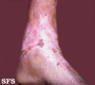epidermolysis bullosa dystrofic dominant
