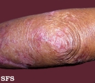 epidermolysis bullosa dystrofic dominant