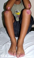 epidermolysis bullosa dystrofic dominant