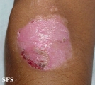 epidermolysis bullosa dystrofic dominant