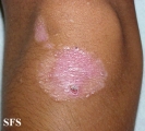 epidermolysis bullosa dystrofic dominant