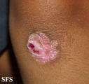 epidermolysis bullosa dystrofic dominant
