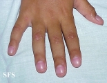 epidermolysis bullosa dystrofic dominant