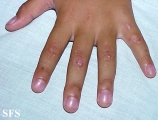epidermolysis bullosa dystrofic dominant