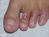 epidermolysis bullosa dystrofic dominant