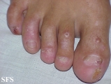epidermolysis bullosa dystrofic dominant