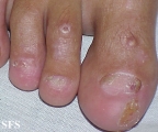 epidermolysis bullosa dystrofic dominant