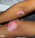 epidermolysis bullosa dystrofic dominant
