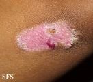 epidermolysis bullosa dystrofic dominant