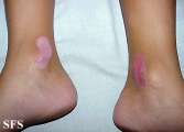 epidermolysis bullosa dystrofic dominant