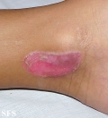 epidermolysis bullosa dystrofic dominant