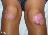 epidermolysis bullosa dystrofic dominant