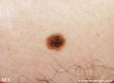 dysplastic_nevus