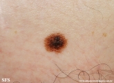 dysplastic_nevus