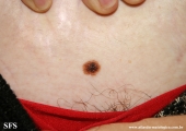 dysplastic_nevus