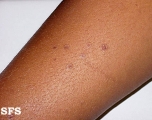 porokeratosis actinic