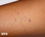 porokeratosis actinic