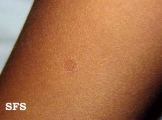 porokeratosis actinic