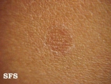 porokeratosis actinic