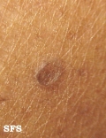 porokeratosis actinic