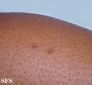 porokeratosis actinic
