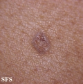 porokeratosis actinic