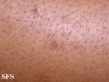 porokeratosis actinic